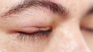 Hausmittel gegen geschwollene Augen und Augenlider