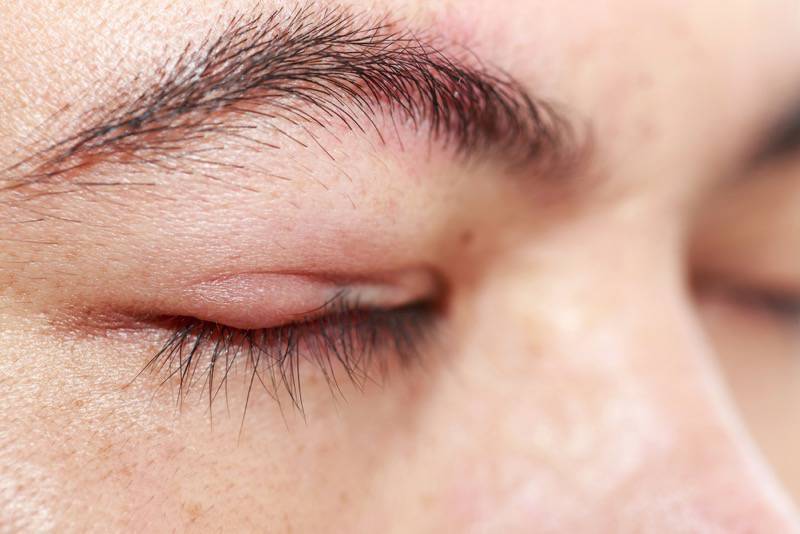 Hausmittel gegen geschwollene Augen und Augenlider