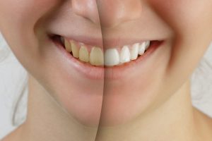 Vorteile & Gefahren von Bleaching der Zähne