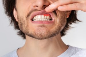 Zahnfleischentzündung behandeln