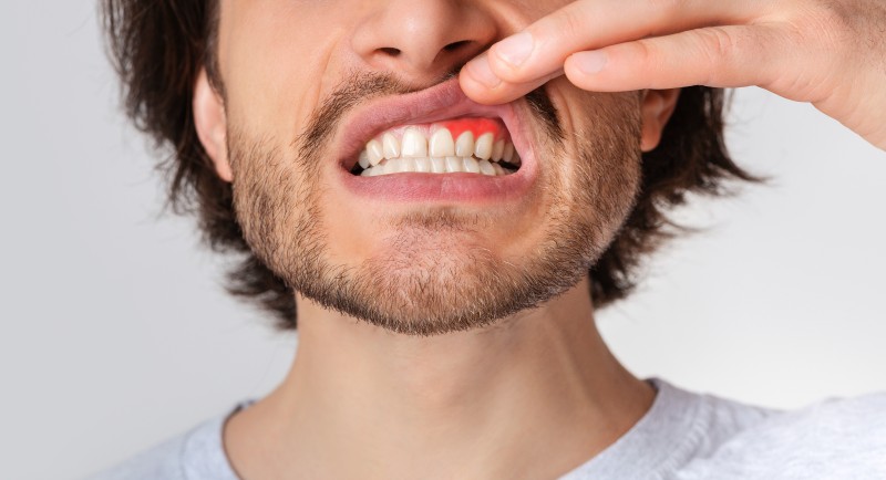 Zahnfleischentzündung behandeln